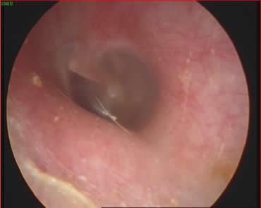 vocal folds